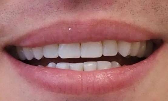 Invisalign-to-protect-from-ongoing-wear-14-aligners-and-Composite-Bonding-After-Image
