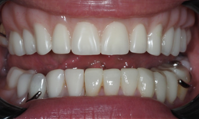 Full mouth restoration results with veneers and dentures in Norwest