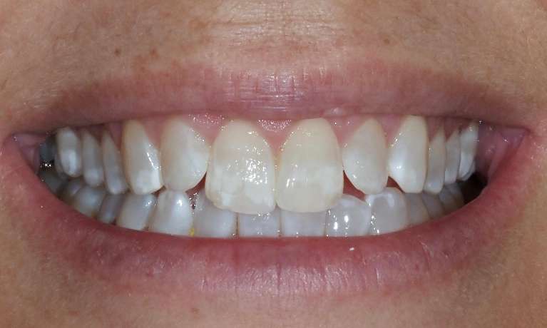 Teeth-Whitening-for-Stubborn-Brown-Markings-After-Image