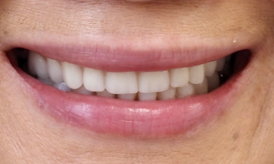 Aesthetic smile results after ceramic veneers and denture treatment in Norwest