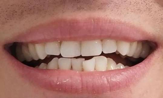 Invisalign-to-protect-from-ongoing-wear-14-aligners-and-Composite-Bonding-Before-Image