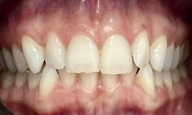 Invisalign-to-Protect-Teeth-From-Wear-Before-Image