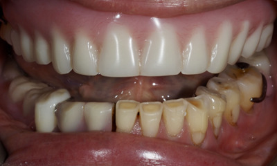 Severe intraoral tooth wear and staining before treatment in Norwest