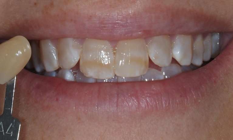 Teeth-Whitening-for-Stubborn-Brown-Markings-Before-Image