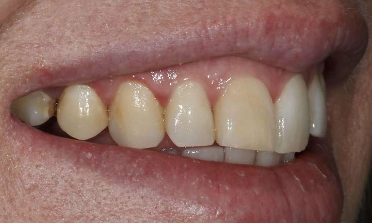 Whitening-for-a-Single-Dark-Tooth-Before-Image
