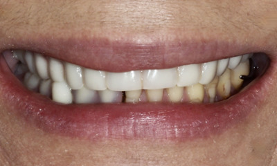 Close-up of smile with severe wear before veneers in Norwest